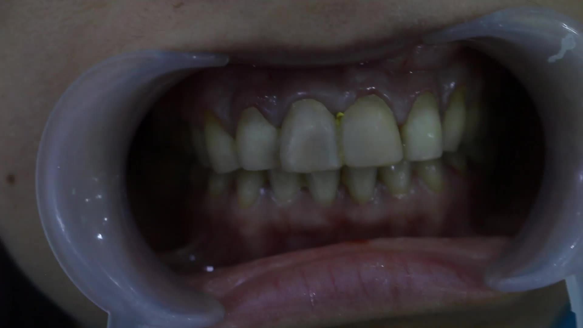 [ Trực tiếp ] Tiến sĩ, Bác sĩ Hà Ngọc Chiều lắp 14 răng sứ thẩm mỹ Emax Đức cho nữ bệnh nhân Tr. T. H - Phủ Lý Hà Nam.