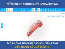 NIỀNG RĂNG TRONG SUỐT INVISALIGN MỸ - BIẾT TRƯỚC KẾT QUẢ SAU ĐIỀU TRỊ.