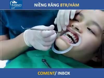 ƯU ĐÃI CHỈ 8 TRIỆU/HÀM ĐỂ NIỀNG RĂNG