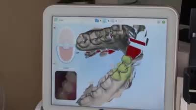 [Trực tiếp] Kỹ thuật viên hãng Invisalign Mỹ thực hiện LẤY DẦU HÀM 3D