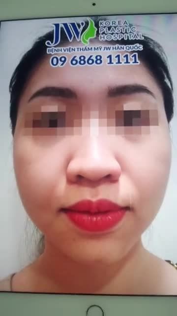 HOT GIRL KHUYẾT CẰM TRỐN GIA ĐÌNH ĐI THẨM MỸ VÀ CÁI KẾT MÃN NHÃN!