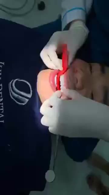 [CẬN CẢNH] Hoàn thành một trong ba ca răng sứ thẩm mỹ tại Jun Dental