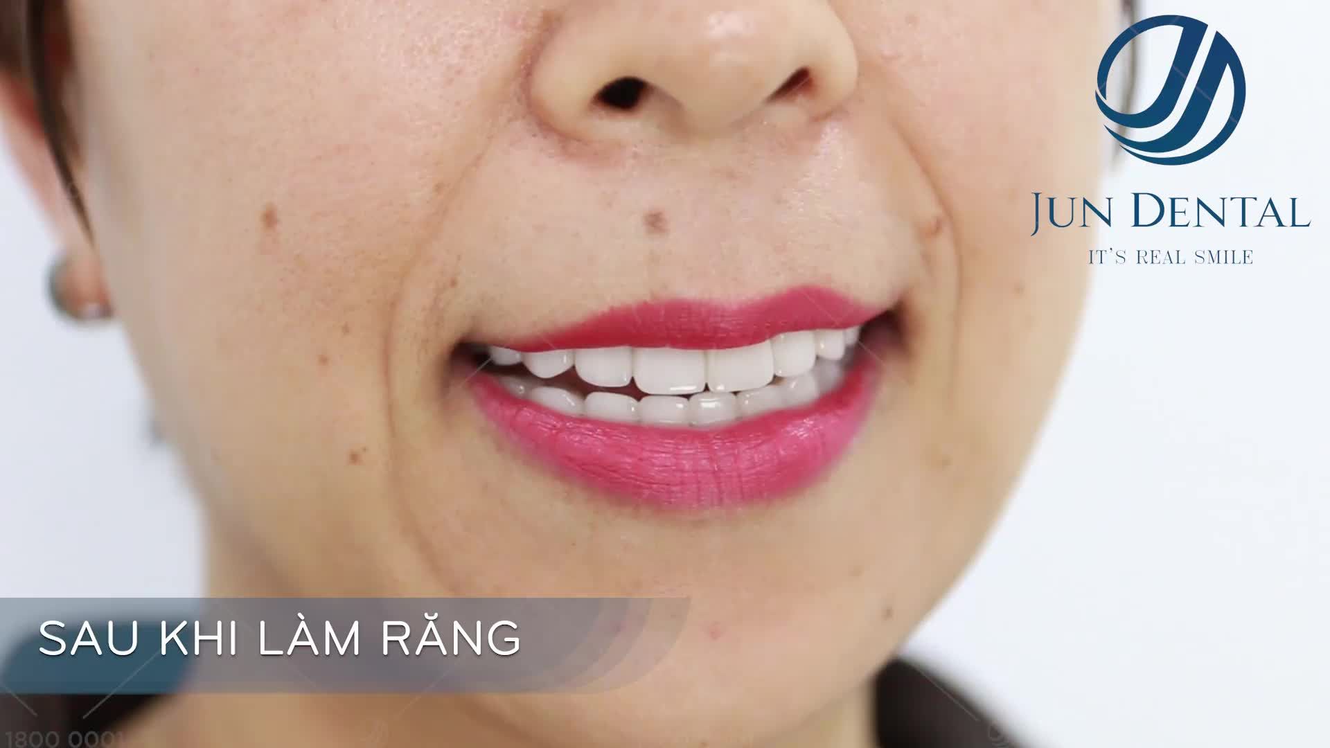 Hình ảnh chị Thu Hòa trước và sau khi làm răng sứ thẩm mỹ tại Jun_Dental bảo tồn răng gốc và vẫn đảm bảo ăn nhai như khi chưa làm răng.