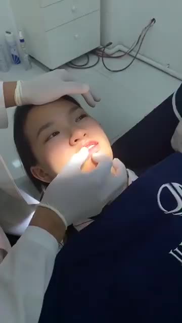 CASE ĐIỀU TRỊ THÀNH CÔNG KHỚP CẮN NGƯỢC TẠI JUN DENTAL