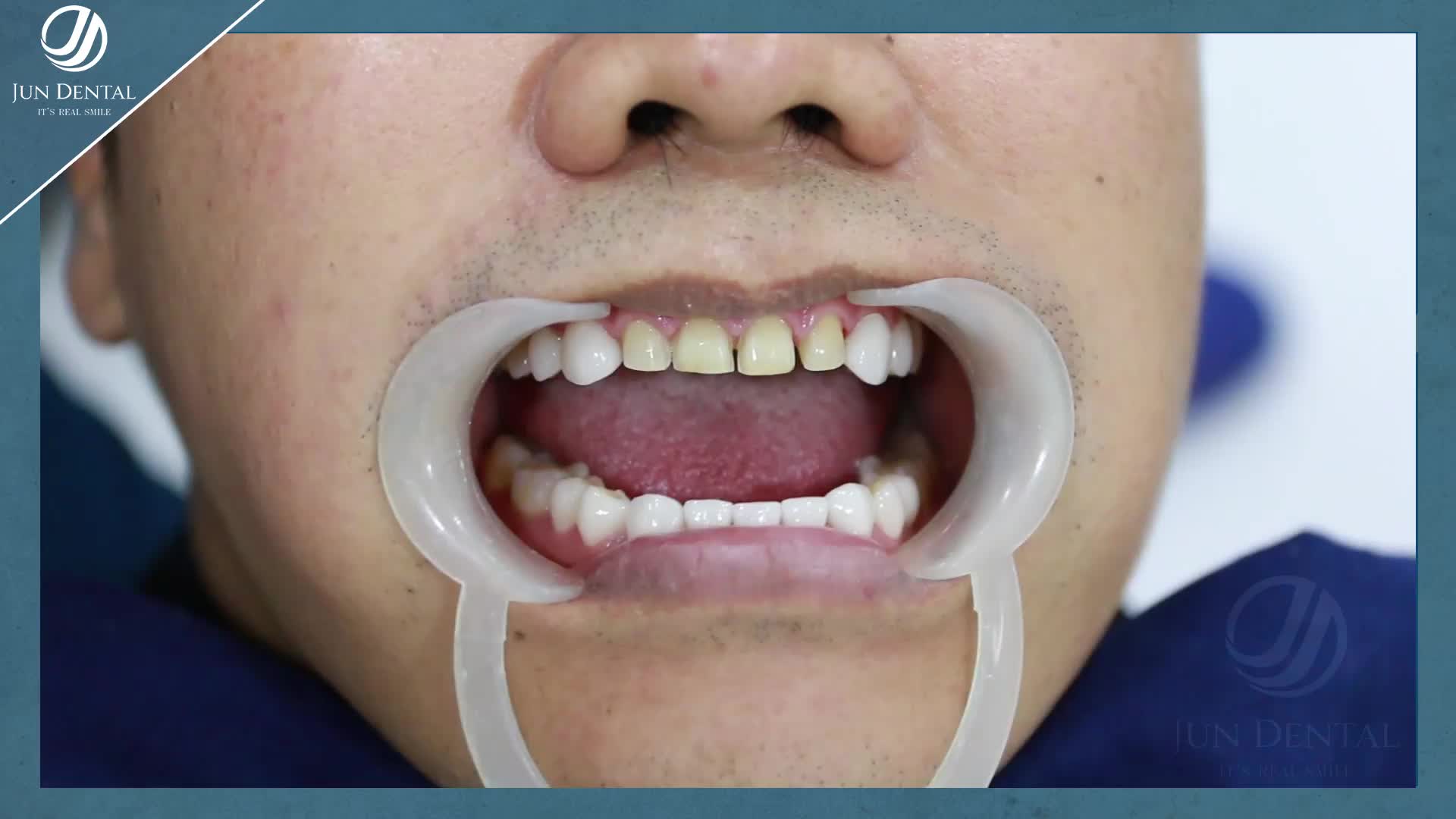 KHÔNG CHỈ CÓ PHỤ NỮ MỚI CẦN CÓ RĂNG ĐẸP