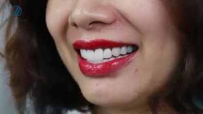 CHỊ HOÀN TOÀN ĐÃ BỊ THUYẾT PHỤC” là lời chia sẻ thật lòng của chị Tuyết Mai sau khi tới tái khám tại Nha khoa Thẩm mỹ Quốc tế Jun Dental.