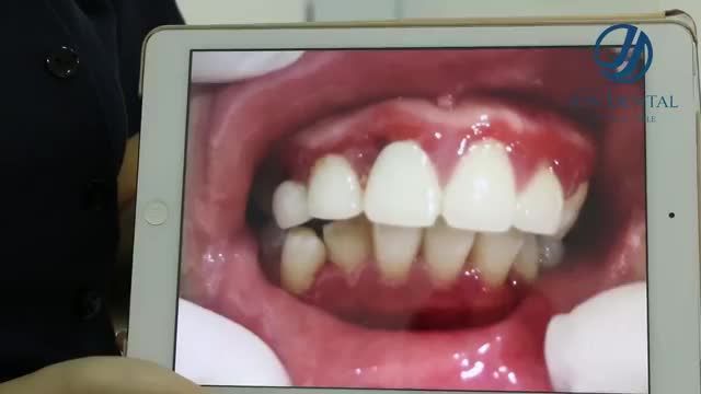 Cùng nghe chia sẻ của chị Mai Hoa về trải nghiệm của chị với việc Phục hình răng sứ cũ hỏng