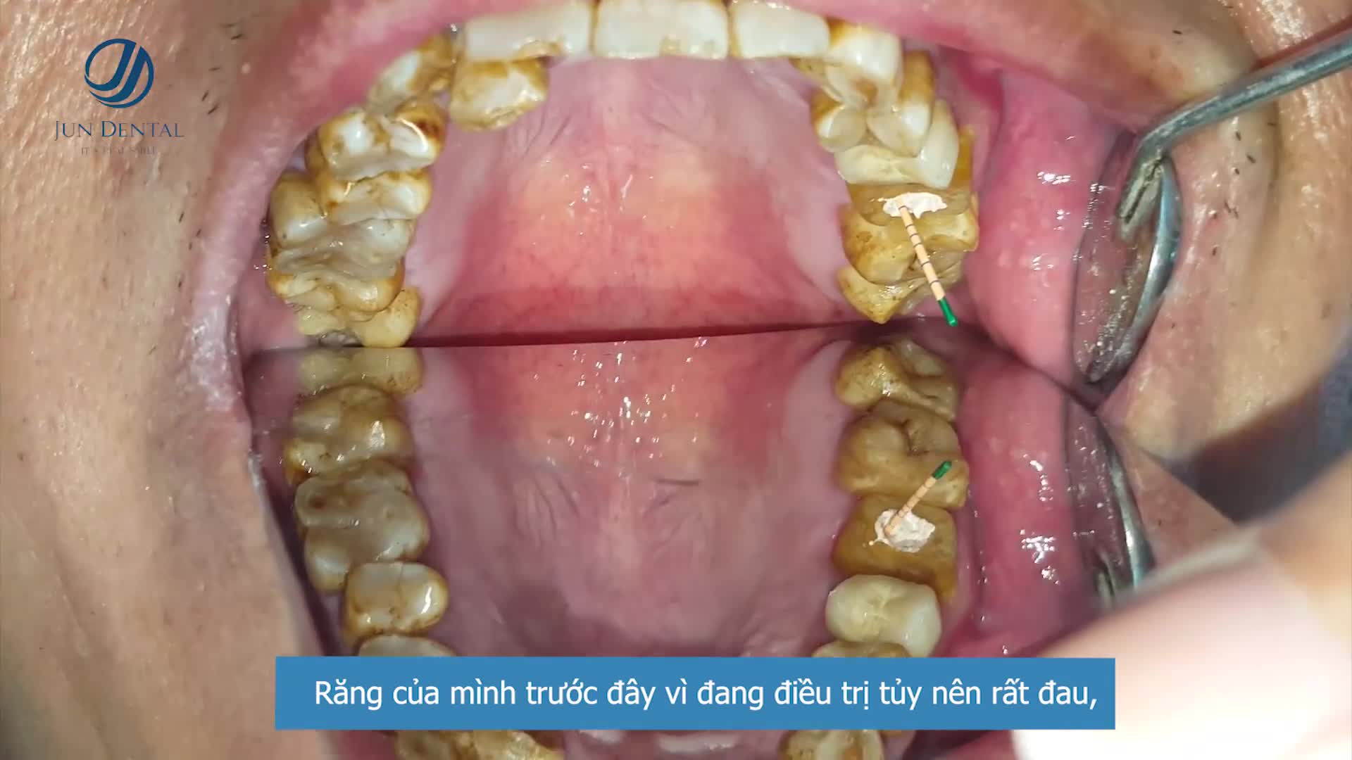Là một trong những khách hàng tìm đến Jun Dental để PHỤC HÌNH RĂNG SỨ do làm sai cách, anh Cường – vị khách hàng đến từ Bắc Ninh chia sẻ