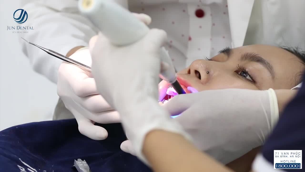 CẬN CẢNH GẮN MẮC CÀI KIM LOẠI TẠI JUN DENTAL