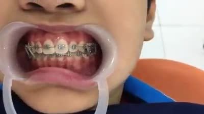 Hình ảnh khách hàng sử dụng niềng răng mắc cài tự buộc sau 07 tháng đến tái khám tại JunDental.