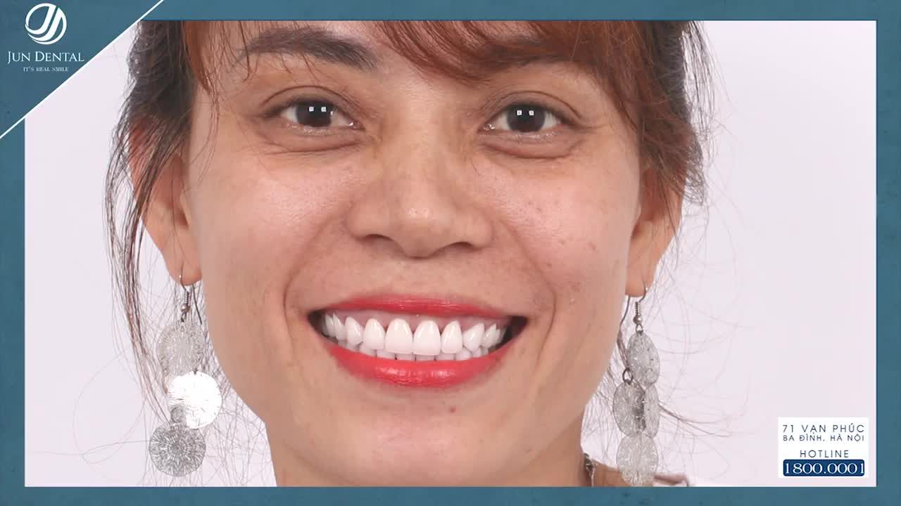 RĂNG HẾT THƯA VỚI RĂNG SỨ CERAMILL ZOLIE
Khách hàng: NguyễnThị Thúy – 38 tuổi, đến từ Quảng Bình