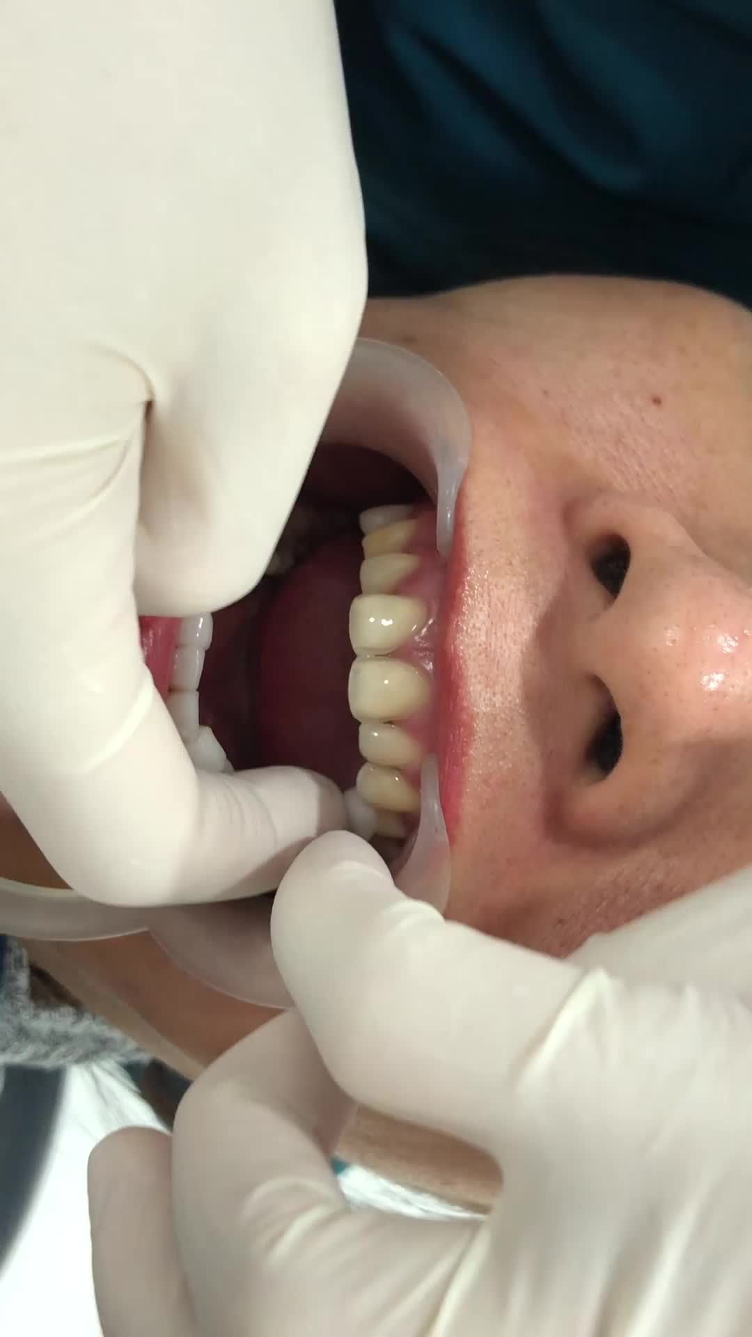 [CẬN CẢNH] Ca lắp răng sứ thẩm mỹ tại Jun Dental cho chị khách vô cùng
