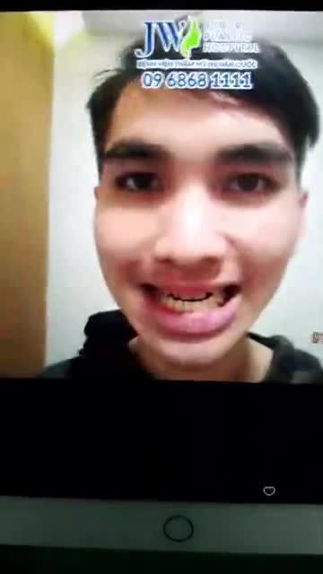 Kết quả phẫu thuật hàm móm tại JW