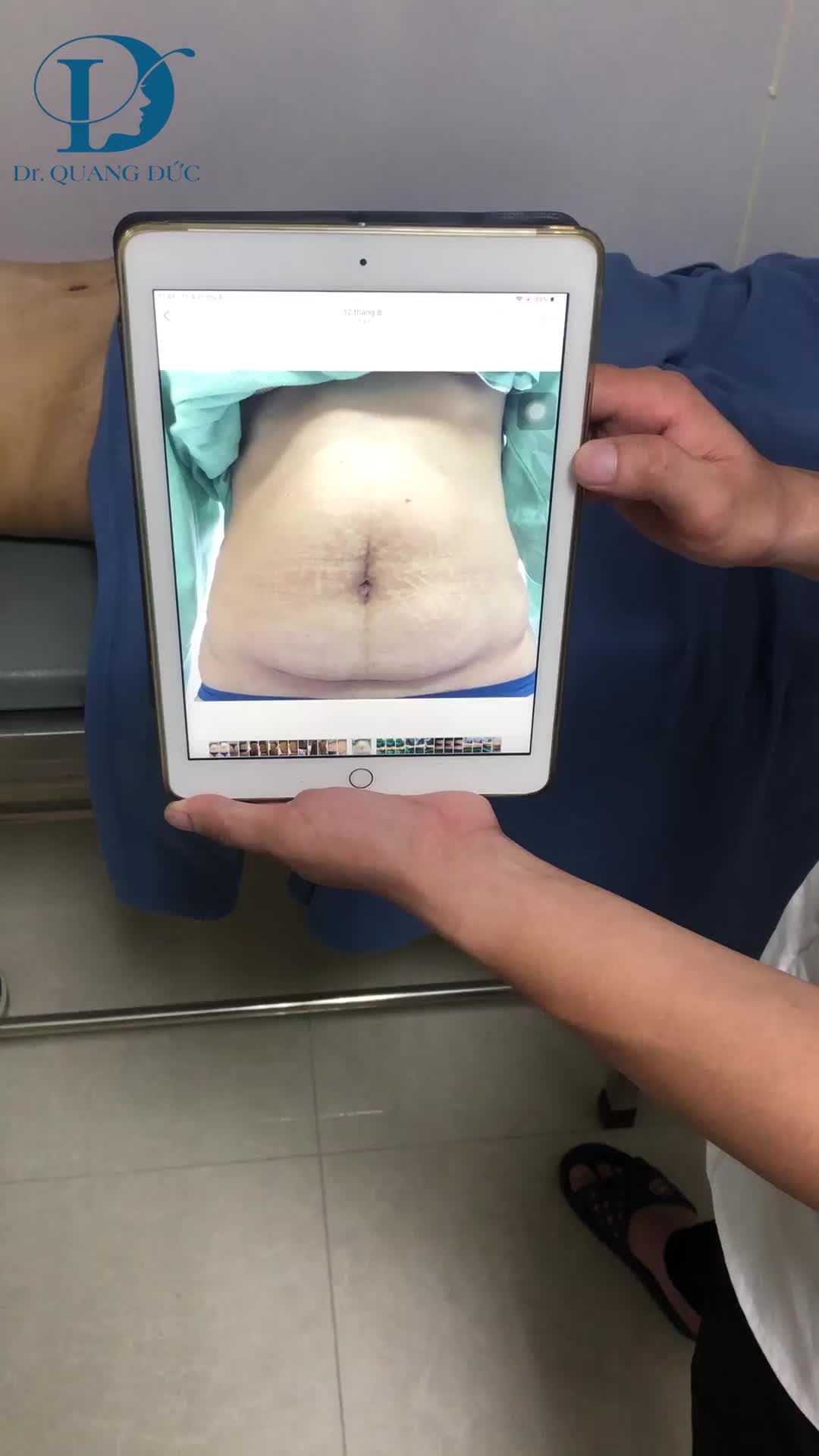 KHÁCH HÀNG TÁI KHÁM SAU 12 NGÀY LÀM BỤNG- ĐẸP MỸ MÃN