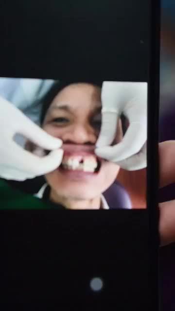 Chú Nguyễn Thanh Xuyền (Hải Dương) đến NK Lạc Việt trong tình trạng mất 1 răng cửa cách đây 3 năm khiến: