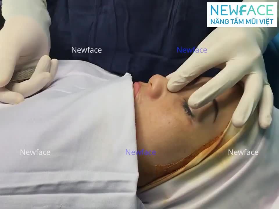 LẤY SỤN SƯỜN SẼ ẢNH HƯỞNG TỚI SỨC KHỎE VÀ KHUNG SƯỜN VỀ SAU: ĐÚNG HAY KHÔNG?