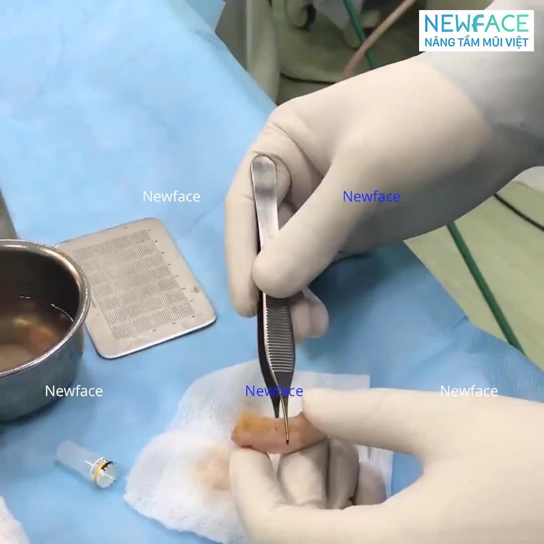 Đoạn sụn sườn để nâng mũi được lấy ra như thế nào?