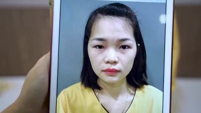 Mắt 1 mí, nhiều mỡ thừa sẽ thay đổi như thế nào sau 30 phút tiểu phẫu Cắt mí Mani Mini Deep 5D