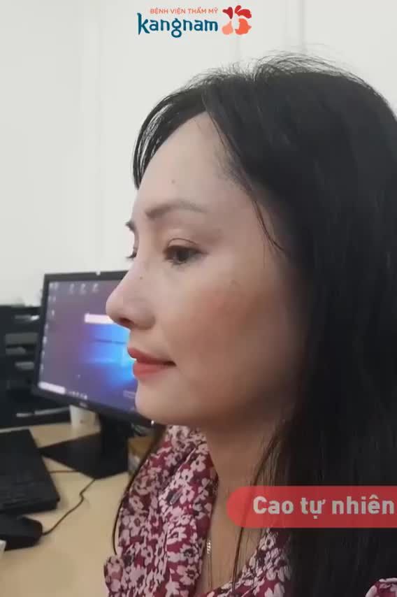 Thay đổi nhan sắc sau NÂNG MŨI CẤU TRÚC 4D