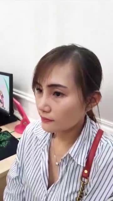 Khách hàng nâng mũi Sline 4D siêu âm