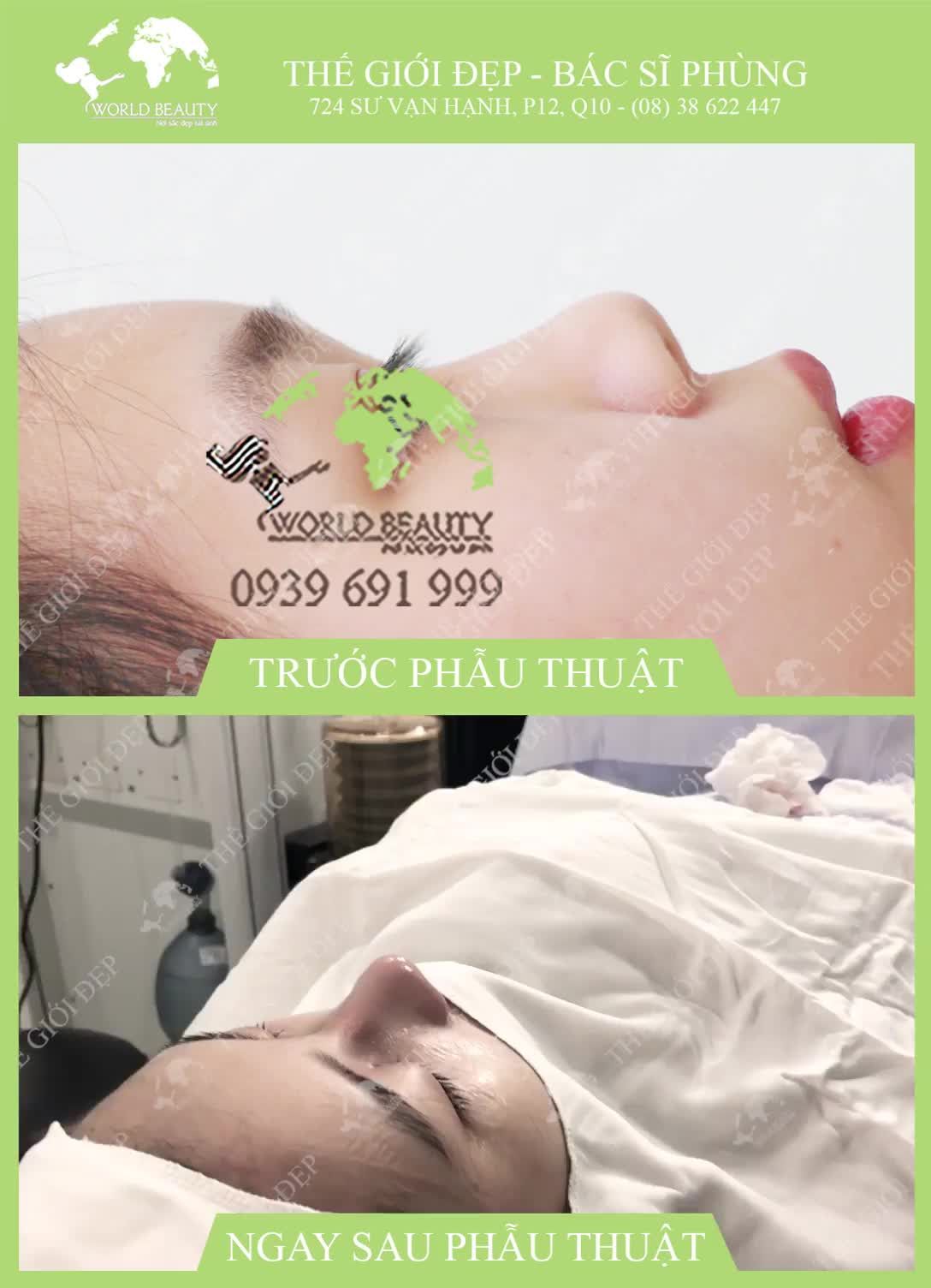 Nâng mũi cấu trúc tại Thẩm Mỹ Tạo Hình Thế Giới Đẹp