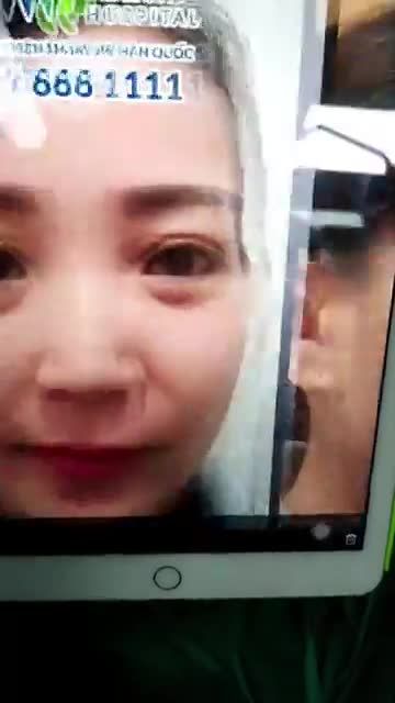 Kết quả nâng mũi cấu trúc Sline tại bệnh viện Thẩm mỹ JW Hàn Quốc