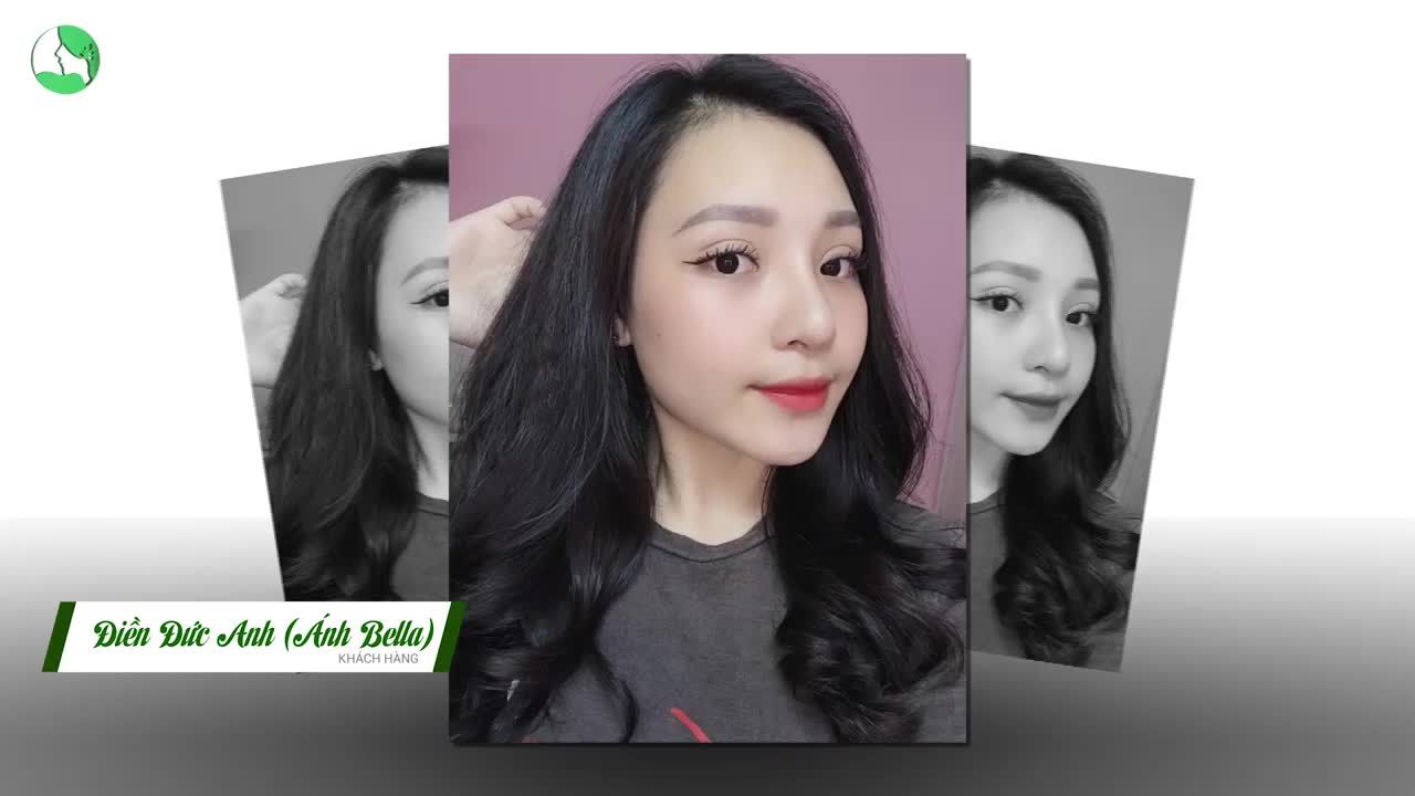 Khuôn mặt cực sang - Thần thái cuốn hút với Nâng mũi High Line