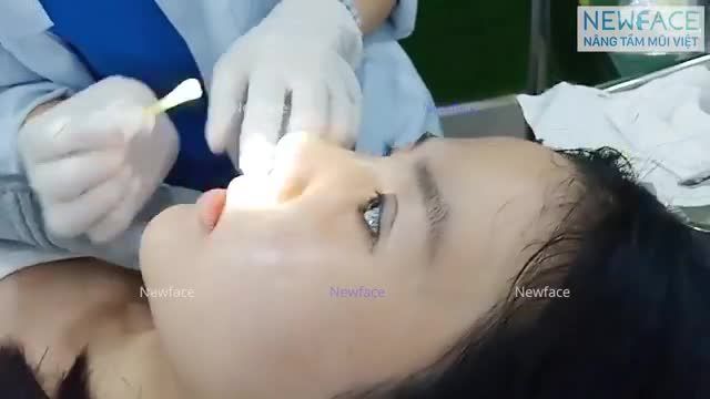 Cận cảnh nâng mũi cấu trúc sụn sườn ngay sau tháo nẹp của khách hàng Việt kiều Canada