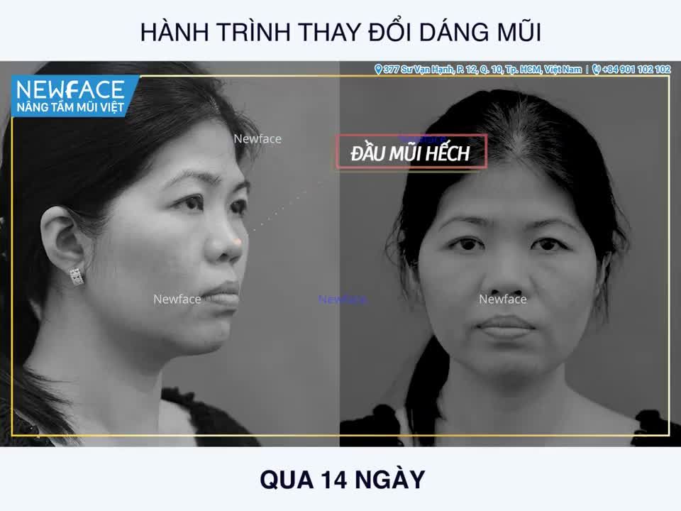 NÂNG MŨI SỤN SƯỜN TỰ THÂN - CHỊ KHÁCH VIỆT KIỀU MỸ "LỘT XÁC" HOÀN HẢO CHỈ SAU 14 NGÀY