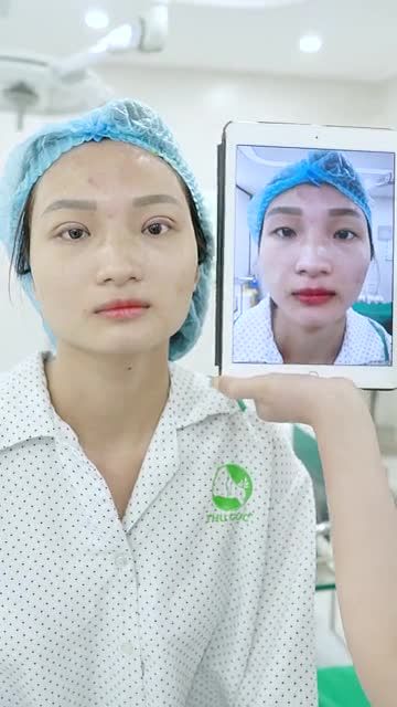 Nếp mí siêu mảnh, siêu nét, cho đôi mắt thêm chiều sâu cuốn hút với CẮT MÍ chỉ 5.8 TRIỆU