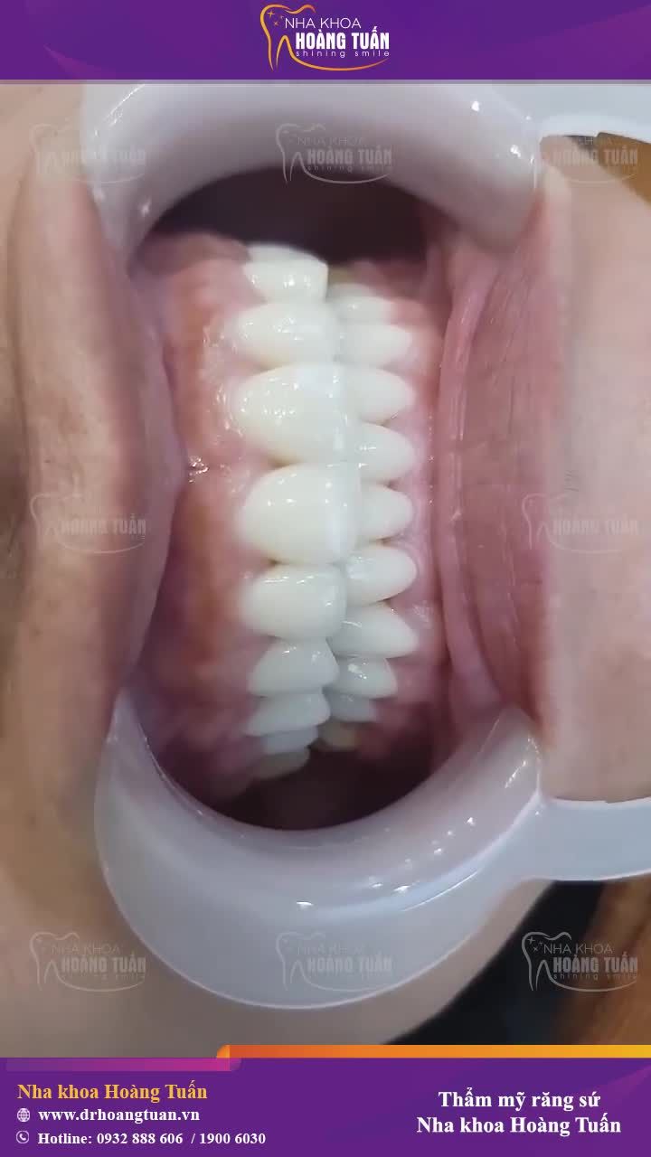 Lợi luôn săn chắc và khỏe mạnh sau phục hình răng sứ thẩm mỹ tại Nha Khoa Hoàng Tuấn