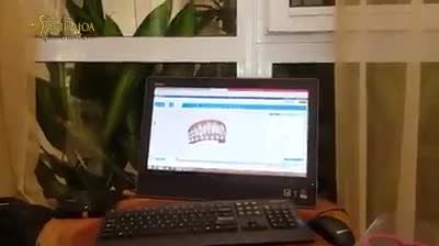 BS.HÒA MÔ PHỎNG QUÁ TRÌNH NIỀNG RĂNG INVISALIGN CHO PHỤ HUYNH