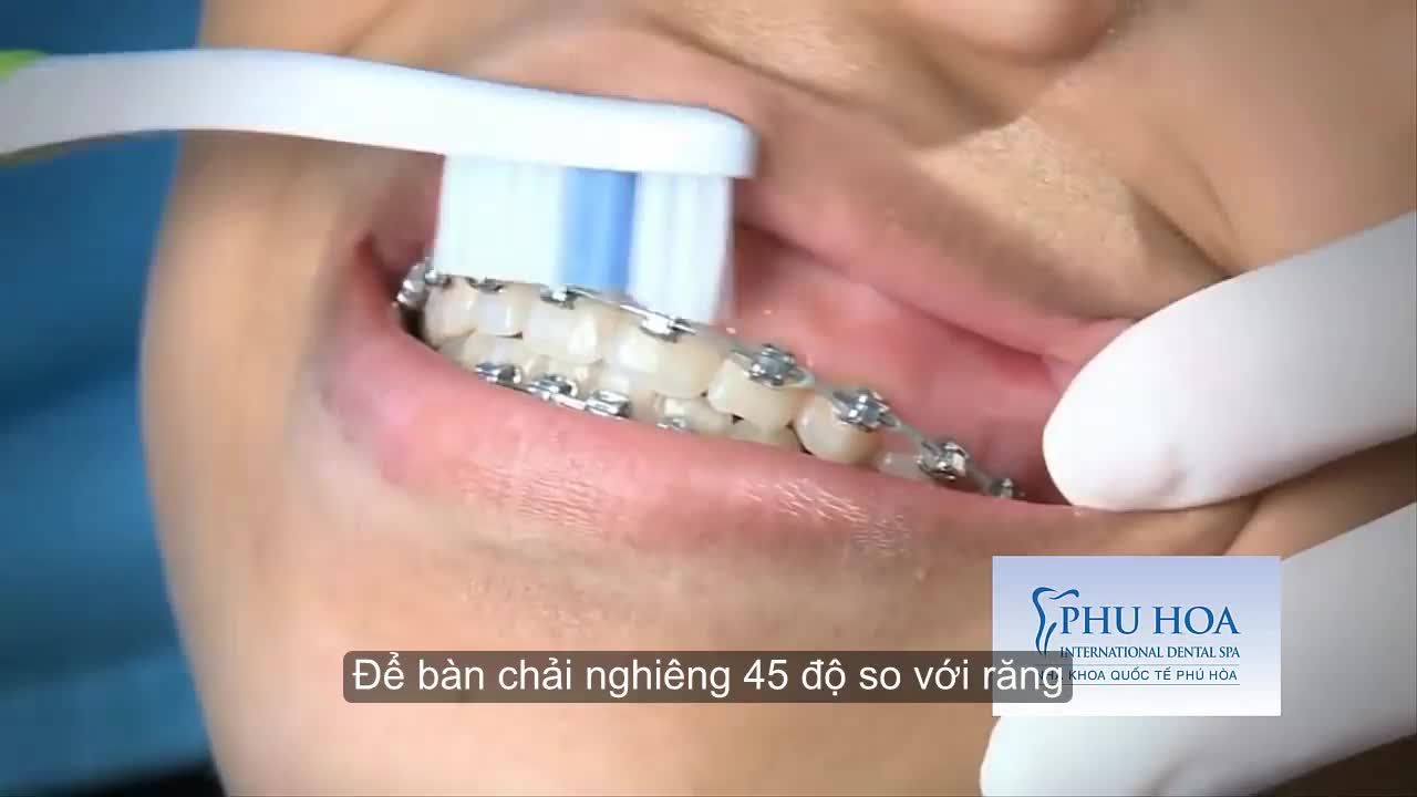 TẤT TẦN TẬT CHĂM SÓC RĂNG MIỆNG KHI ĐEO MẮC CÀI