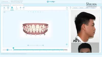 Chỉnh nha Invisalign hay còn gọi là niềng răng không mắc cài, là một cuộc cách mạng trong thẩm mỹ nha khoa.