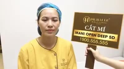 Cùng xem sự thay đổi của vị khách hàng xinh đẹp sau khi cắt mí mắt Mani Mini Deep 5D của Dr.Hải Lê