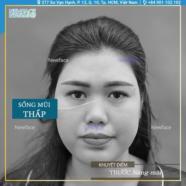 PHÚT TRẢI LÒNG CỦA BẠN CHI TRƯỚC KHI BƯỚC VÀO CA PHẪU THUẬT NÂNG MŨI SỤN SƯỜN