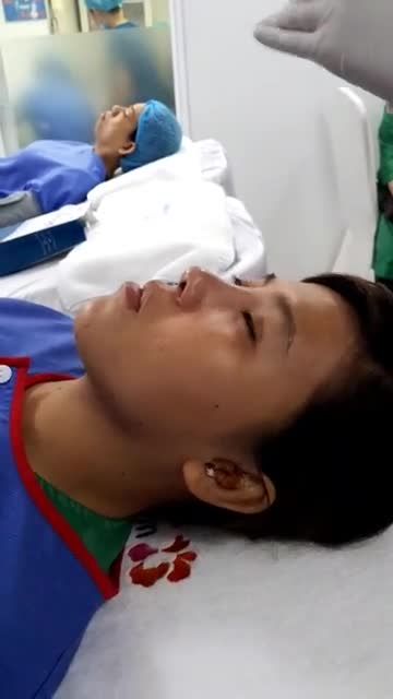 Quy trình nẹp mũi Sline 4D