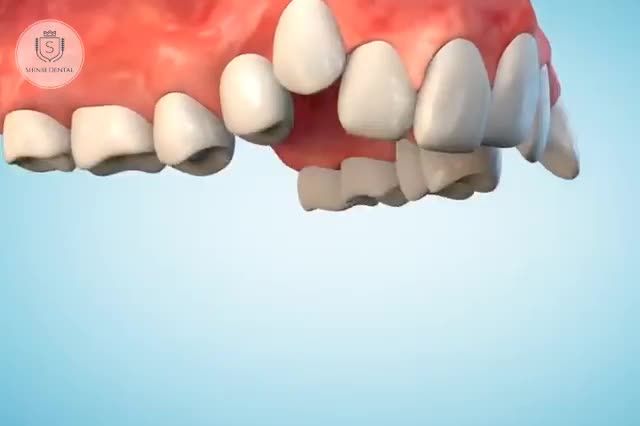Niềng răng mắc cài là phương pháp truyền thống được đa số lựa chọn