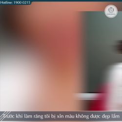 SAU 2 NĂM LÀM RĂNG SỨ THẨM MỸ TẠI SHINBI, ĐẾN KIỂM TRA LẠI TÌNH TRẠNG RĂNG VẪN ĐẸP NHƯ MỚI LÀM