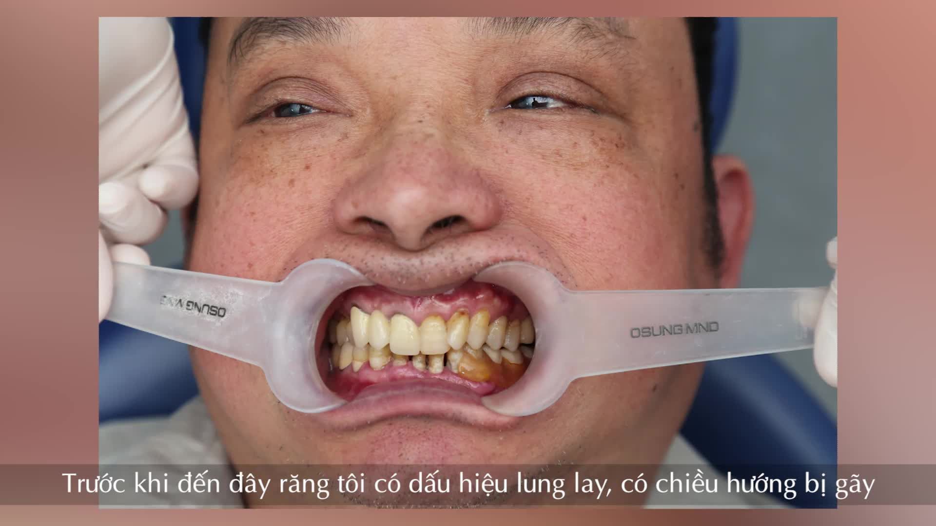 TÔI ĐÃ CHỌN ĐƯỢC GÓI LÀM RĂNG PHÙ HỢP VỚI CẢ SỨC KHỎE VÀ KINH TẾ TẠI SHINBI