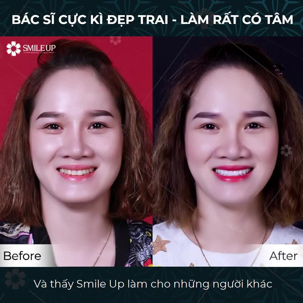 CASE 4084: RĂNG VÀNG Ố, MÒN MẶT NHAI.