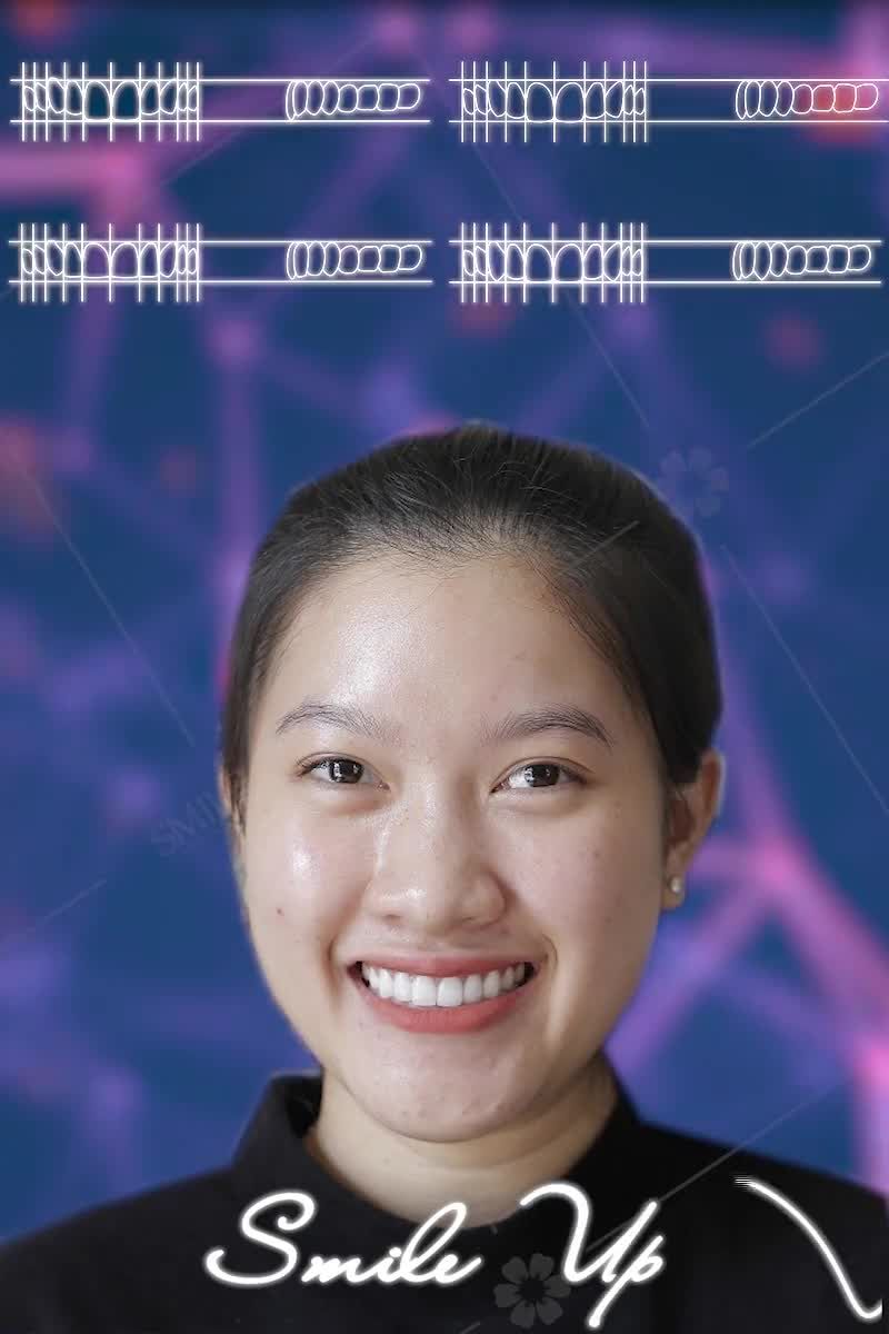 RĂNG THƯA, Ố VÀNG - BIẾN MẤT CHỈ SAU 2 NGÀY