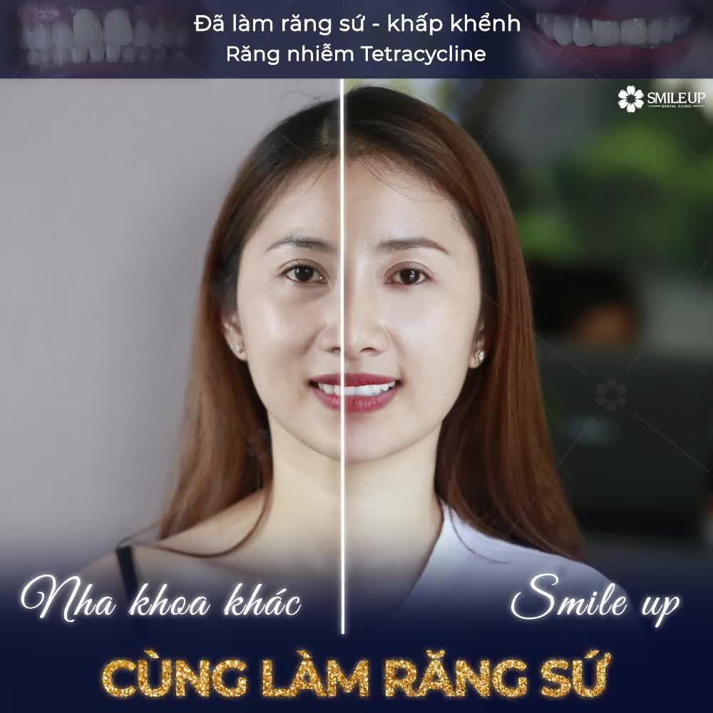 GIẢI PHÁP CHO RĂNG NHIỄM TETRACYCLINE, KHẤP KHỂNH.