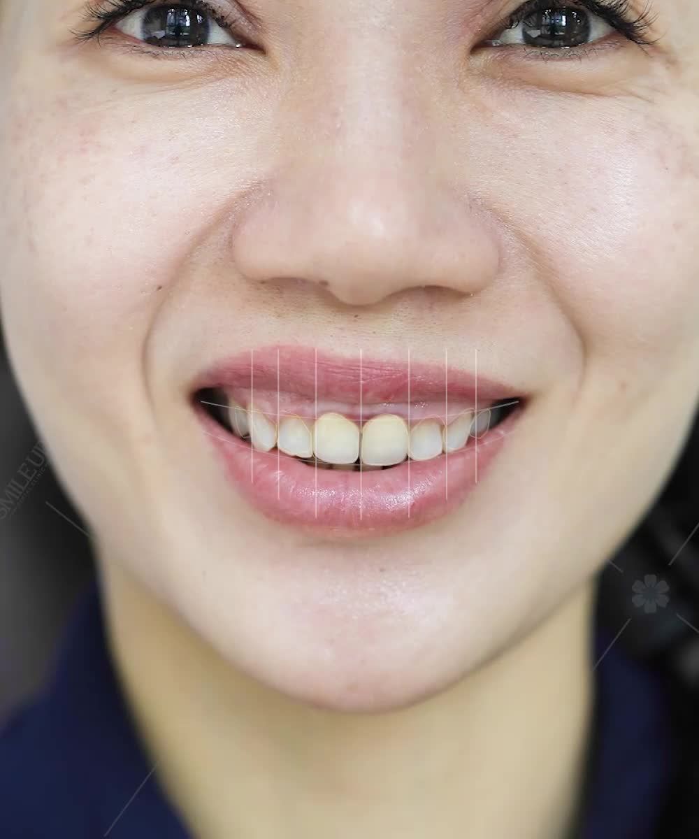 CASE 4083: HÔ HÀM, CƯỜI HỞ LỢI, VIÊM CHÂN RĂNG, ĐÃ TỪNG LÀM 2 RĂNG CỬA