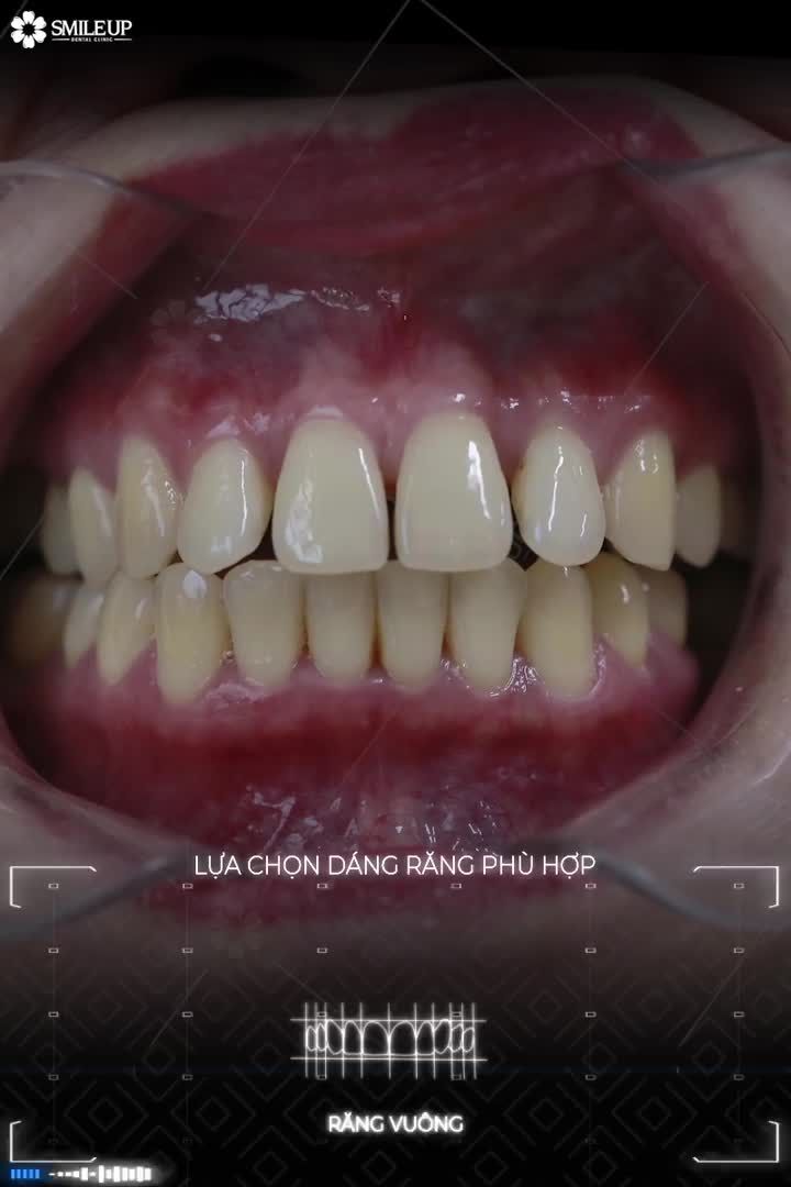 CASE 4085: RĂNG CỬA THƯA NHIỀU, Ố VÀNG.