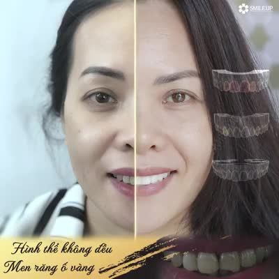 RĂNG NHIỄM TETRACYLINE - ĐÃ CÓ GIẢI PHÁP TỐI ƯU
