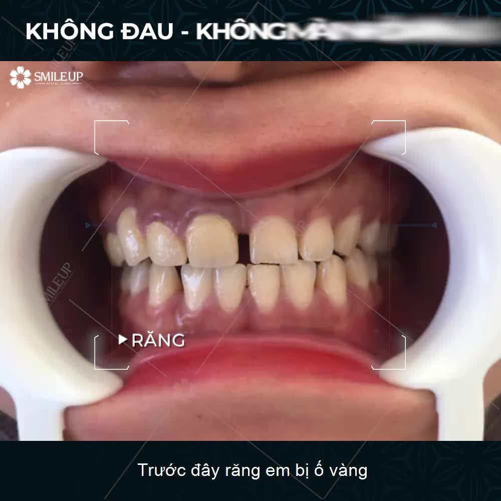 CASE 4080: RĂNG VÀNG Ố, 2 RĂNG CỬA R11, R21 THƯA NHIỀU.
