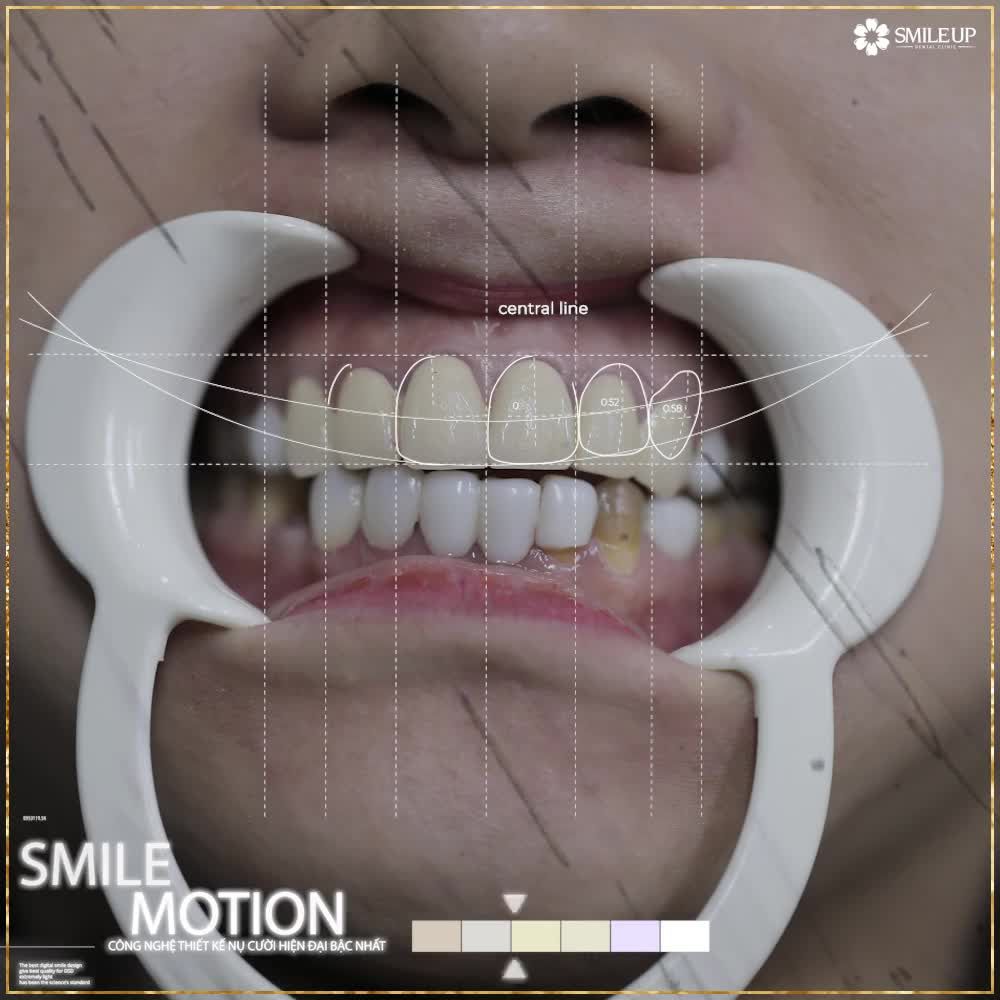 ĐẾN SMILE UP - TẠM BIỆT HÀM RĂNG SỨ CŨ KHÔNG ƯNG Ý NGAY