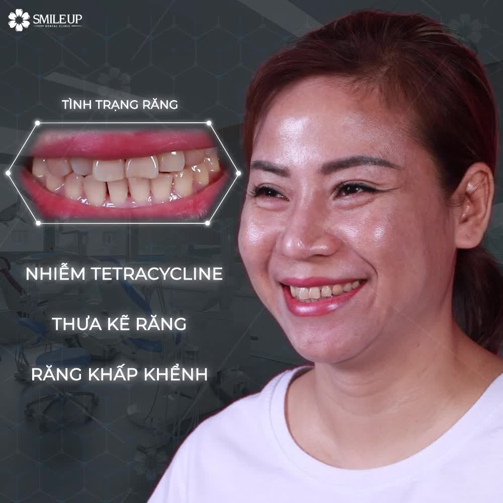 HÔ BIẾN HÀM RĂNG THƯA, NHIỄM TETRACYLINE...CHỈ SAU 2 LẦN HẸN