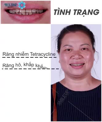 CASE 3089: TẠM BIỆT HÀM RĂNG NHIỄM TETRACYLINE BẰNG PHƯƠNG PHÁP PHỦ SỨ ĐỘC QUYỀN